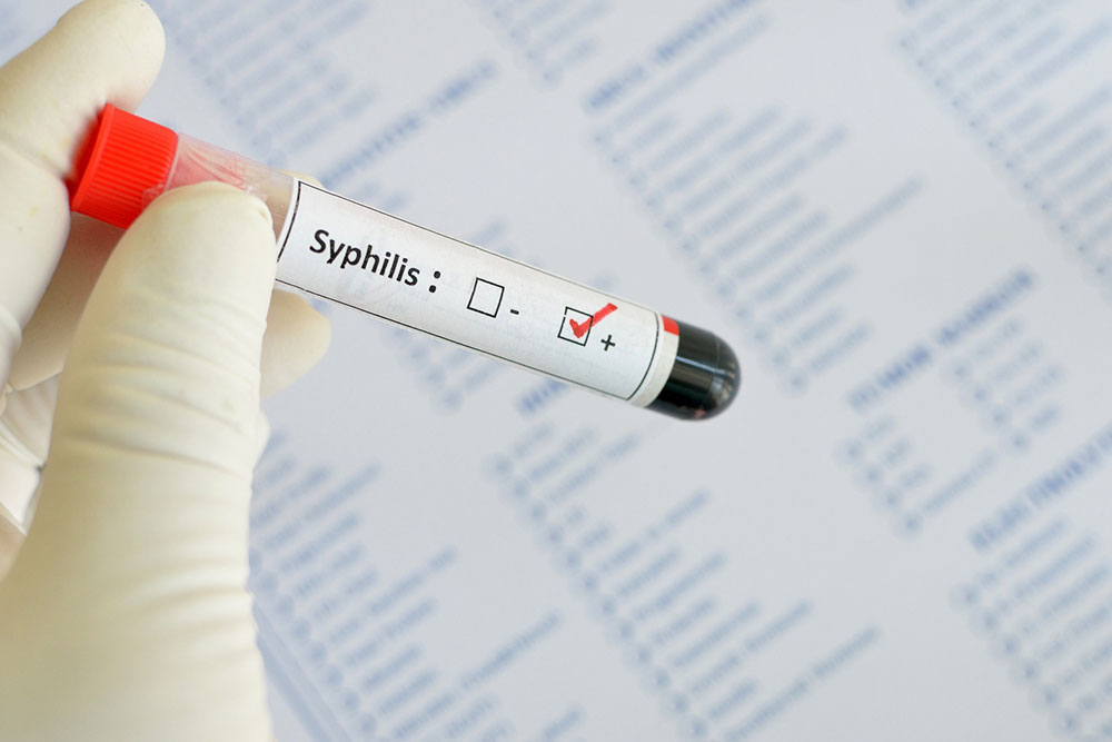 Syphilis &#8211; Early Signs and Diagnosis