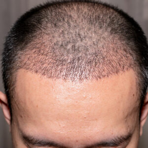 Hair Transplant – Types, Benefits, and Tips to Choose a Doctor