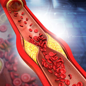 8 Ways to Manage Plaque in Arteries