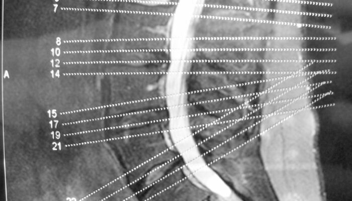 A brief overview of degenerative disc and joint disease