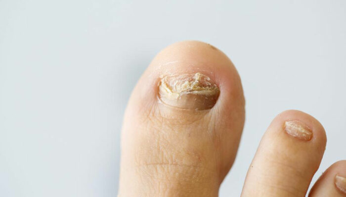 Common nail infections to avoid