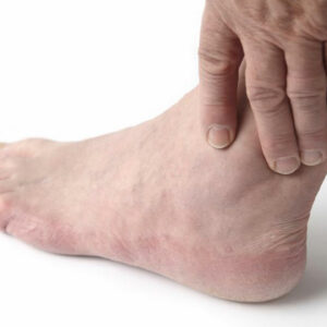 Home treatment for relief from gout foot pain