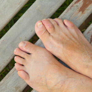 Home remedies for curing toenail fungus