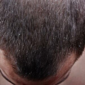 Scalp Psoriasis