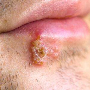 Signs that tell you might have herpes