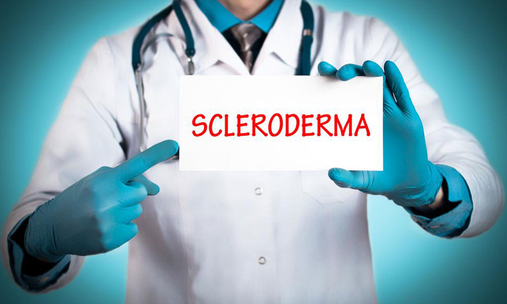 Treating the early symptoms of scleroderma