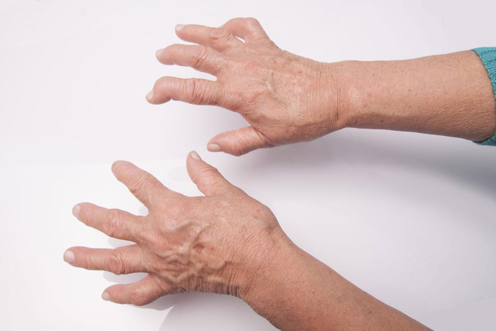 A Quick Guide of Rheumatoid Arthritis Drugs