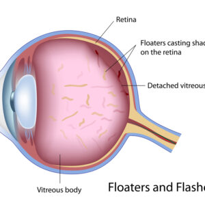 All About Eye Floaters And How To Get Rid Of Them