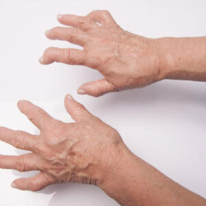 All You Need to Know About the Diagnosis of Rheumatoid Arthritis