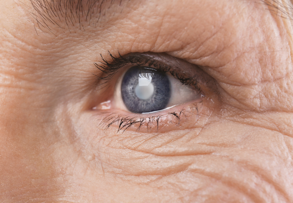 All You Need to Know about Cataract