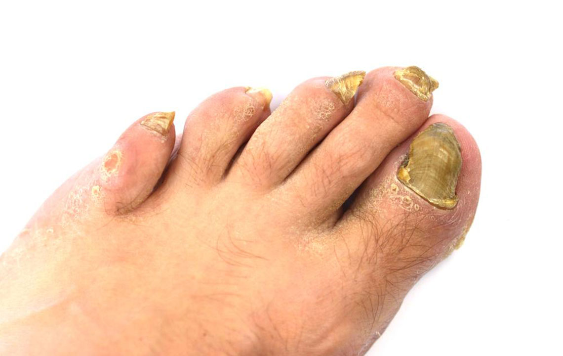 An Effective Way to Treat Toenail Fungus &#8211; Hydrogen Peroxide