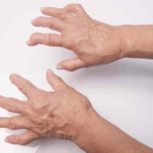 Food Items You Should Avoid When Suffering from Arthritis