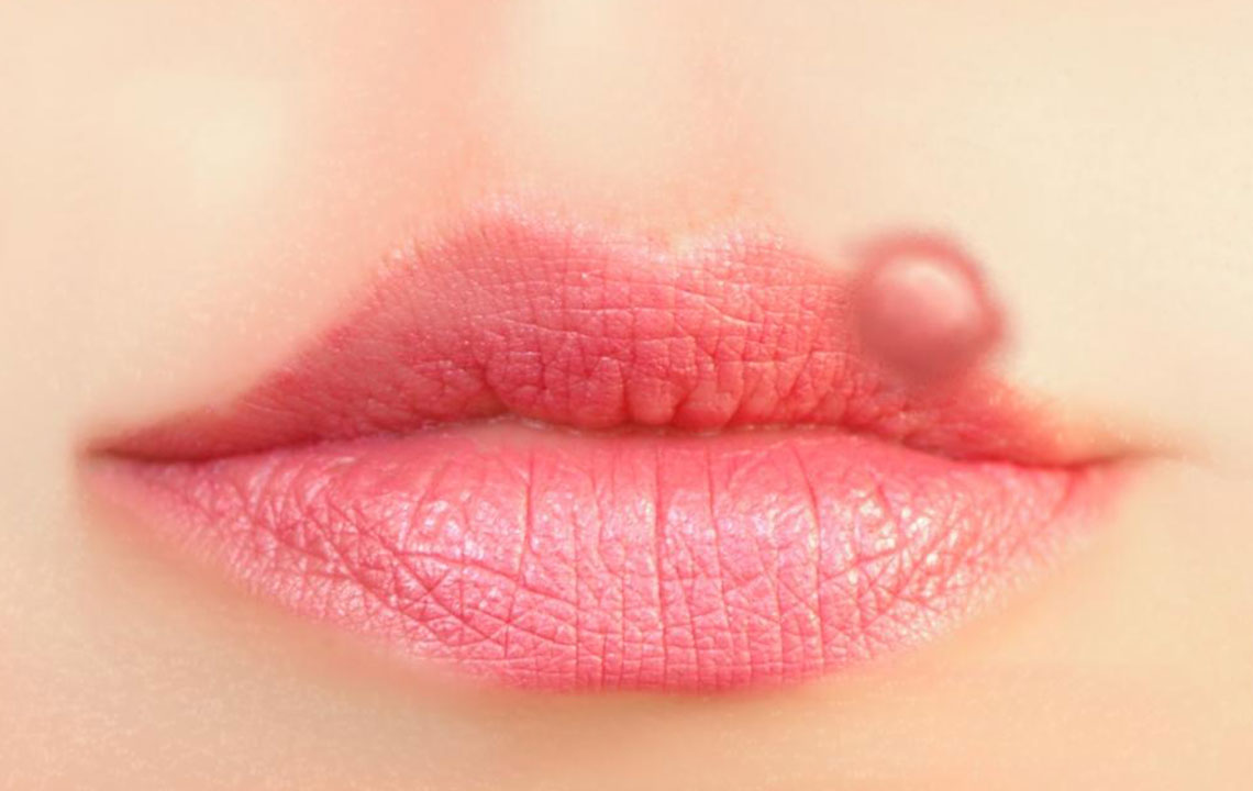 Get Quick Relief from Cold Sores