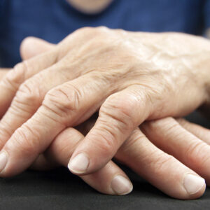 Know about the stages, diagnosis, and prevention of arthritis