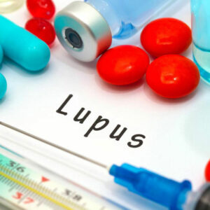 Lupus – An Overview