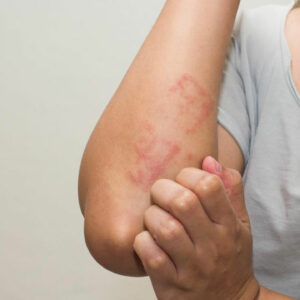 Lupus Skin Rash &#8211; Symptoms and Treatment