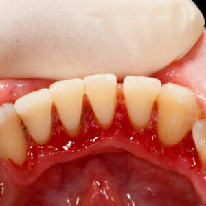 Top 8 natural treatments for gum disease