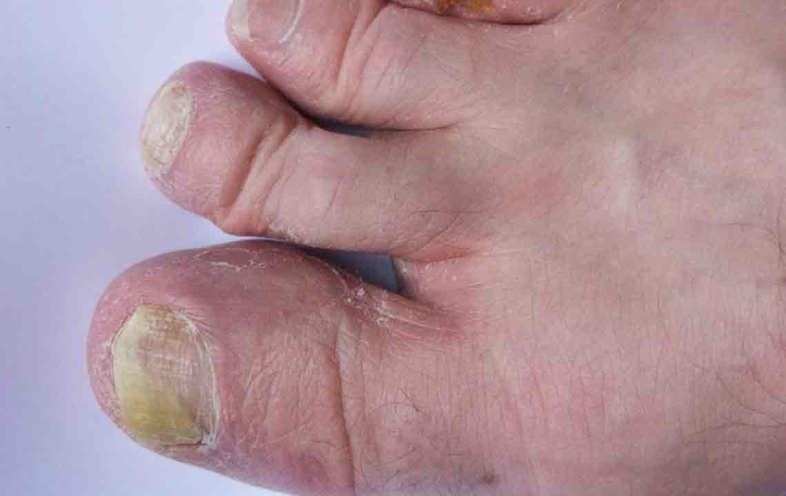 Using Listerine for Curing Toenail Fungus