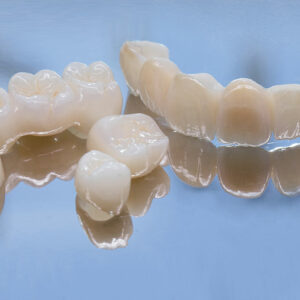 Things to Know Before Opting for Dental Bridges