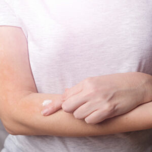 Itchy Skin – Best Anti-Itch Creams and Home Remedies